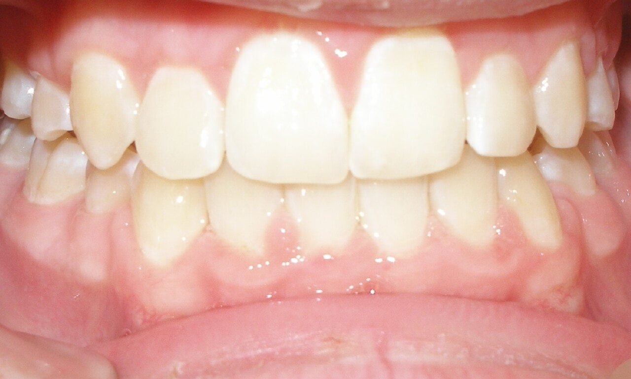 Crossbite Case Study