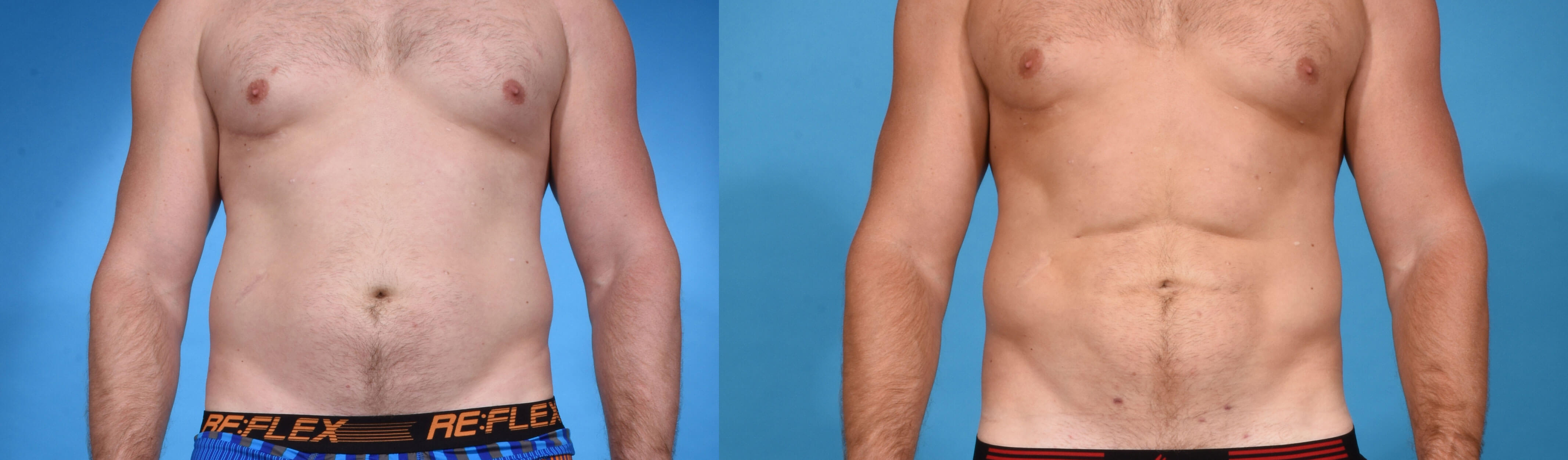 Abdominal Etching with High Definition Liposculpting