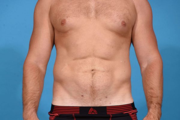 Abdominal Etching with High Definition Liposculpting