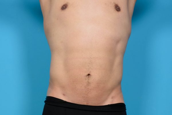 Abdominal Etching Plus Vaser