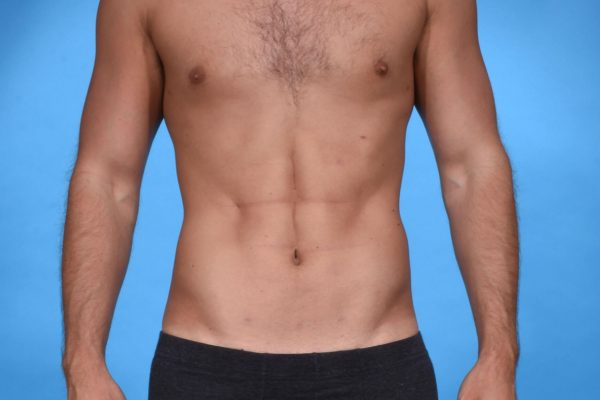 Abdominal Etching