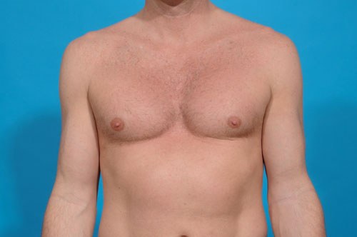 Pectoral Implants