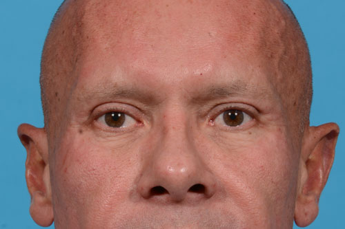 Upper Eyelid Lift