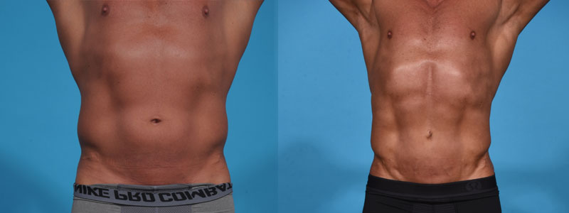 Abdominal Etching with high definition Liposculpting.
