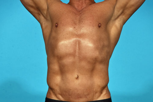 Abdominal Etching with high definition Liposculpting.