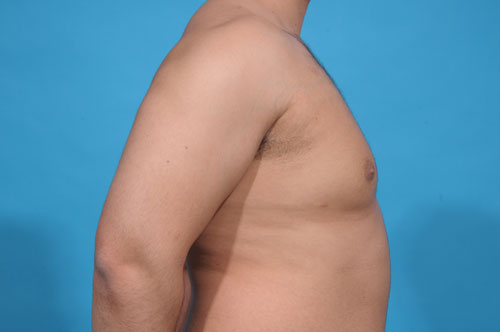 Gynecomastia