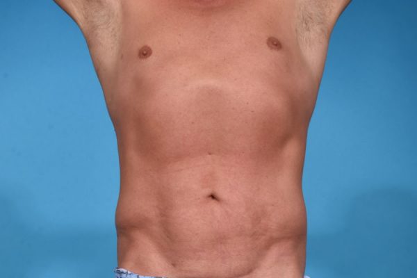 Hi-definition VASER Lipocontouring and Liposculpting
