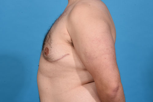 Gynecomastia Excision, VASER Liposculpting