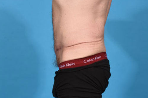 Tummy Tuck