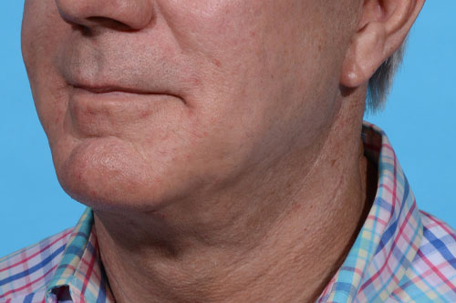 Neck Lift