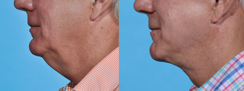 Neck Lift