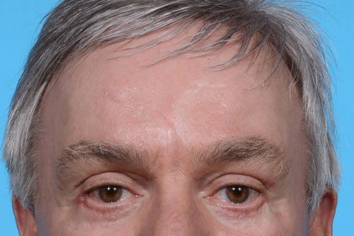Forehead and Brow Lift Plus Eyelid Lift