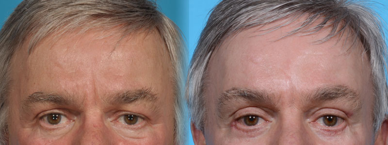 Forehead and Brow Lift Plus Eyelid Lift
