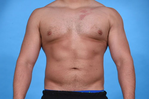 High definition VASER Assisted Liposculpture