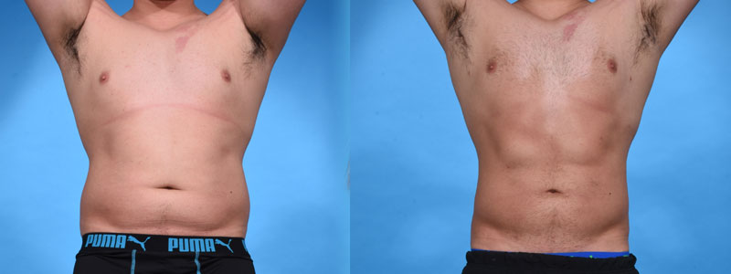 High definition VASER Assisted Liposculpture