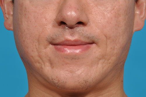 Upper Lip Lift