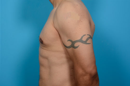 Gynecomastia Excision Plus Hi-Definition VASER Liposculpture