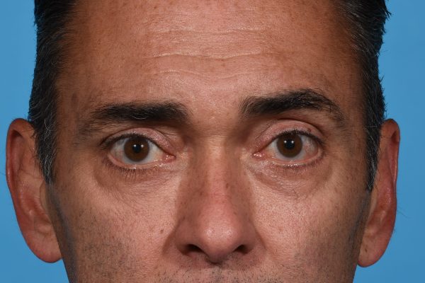 Lower Eyelid Lift