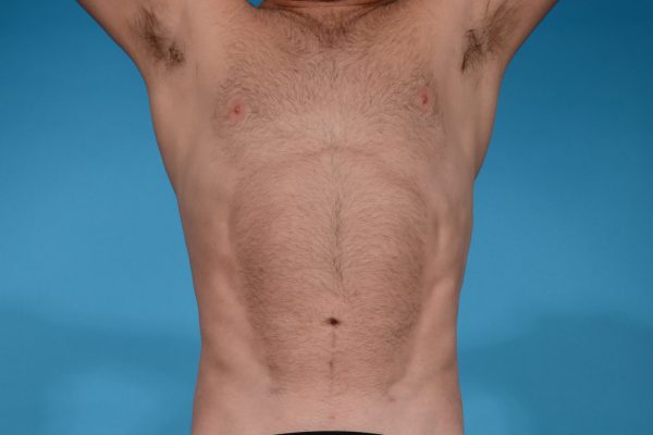 ABDOMINAL ETCHING WITH VASER HI-DEFINITION LIPOSCULPTING