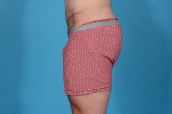 After Weight Loss Fitness Surgery