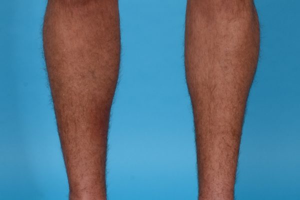 Calf Augmentation With Calf Implants Dallas, Texas
