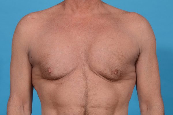 Central Physique Etching with Pectoral Augmentation in Dallas, TX