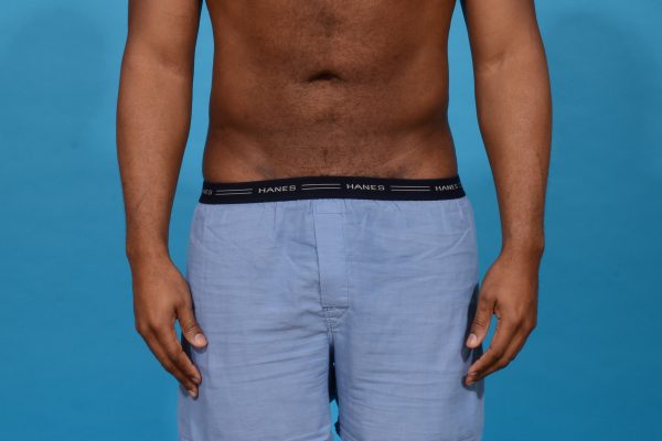 Central Physique Etching in Dallas, Texas