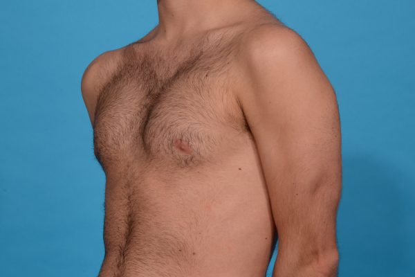 Chest Contouring with Pectoral Augmentation in Dallas, Texas