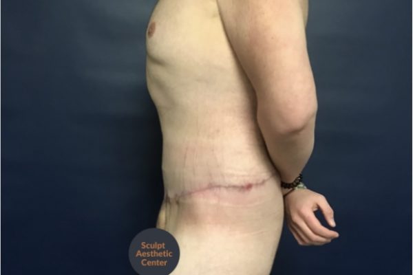 After Weight Loss Fitness Surgery