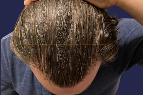 Hair Restoration in Dallas, Texas