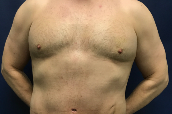360 Body Lift with Gynecomastia Excision