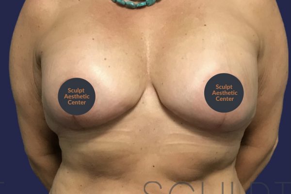 Mastopexy with Breast Implant Exchange