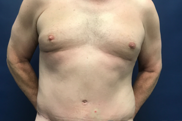 Core Physique SCULPTing with Male Tummy Tuck