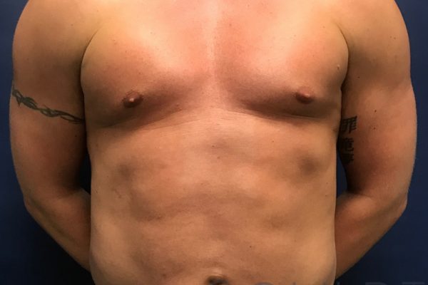 Liposuction to the Abdomen, Chest, Keller, TX