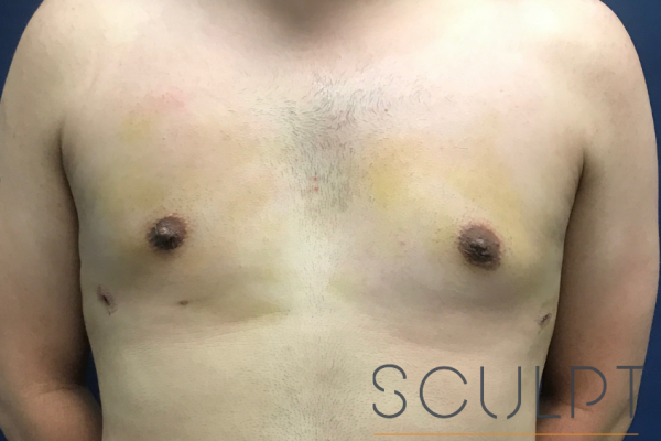 Gynecomastia Excision with Chest SCULPTing, McKinney, TX