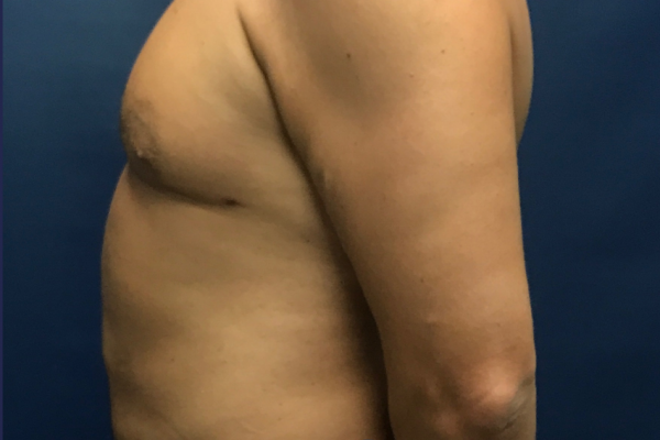 Liposuction to the Abdomen, Chest, McKinney, TX