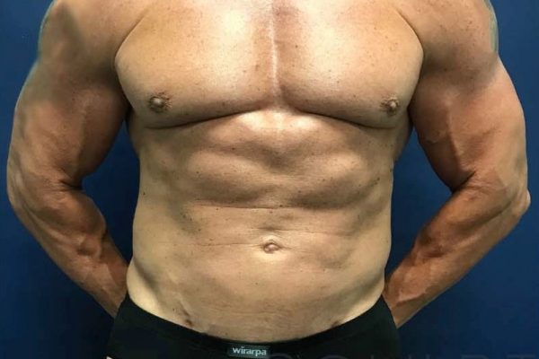 Liposuction to the Abdomen, McKinney, TX