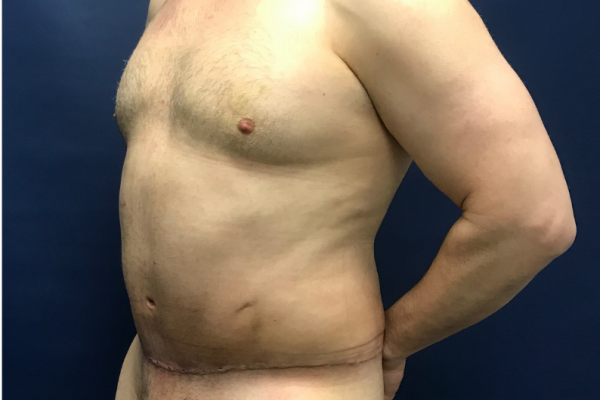 360 Body Lift with Gynecomastia Excision