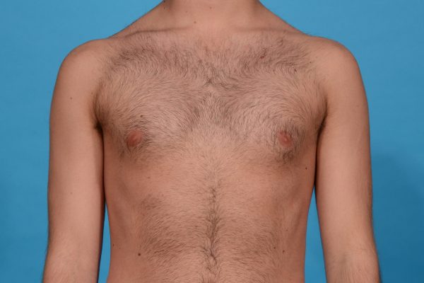 Chest Contouring with Pectoral Augmentation in Dallas, Texas