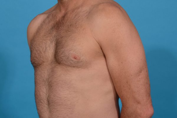 Chest Contouring with Abdominal Etching in Dallas, Texas