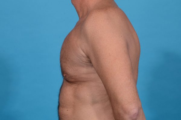 Central Physique Etching with Pectoral Augmentation in Dallas, TX