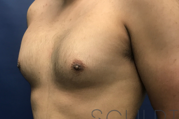 Gynecomastia Excision with Chest SCULPTing, Dallas, TX