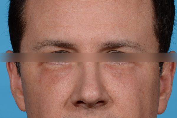 Lower Blepharoplasty Dallas, Texas