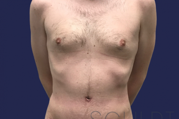 Male Tummy Tuck, Dallas, TX