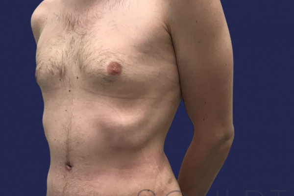 Liposuction to the Abdomen, Chest, Dallas, TX