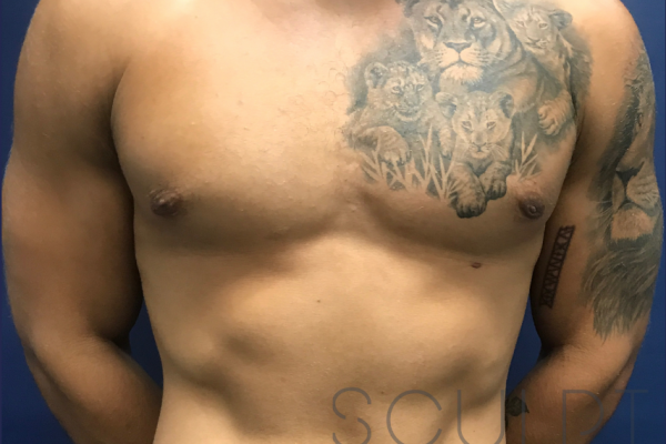 Gynecomastia Excision, Carrollton, TX