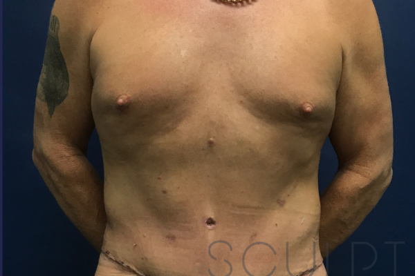 Liposuction to the Abdomen, Chest, Back, Arlington, TX