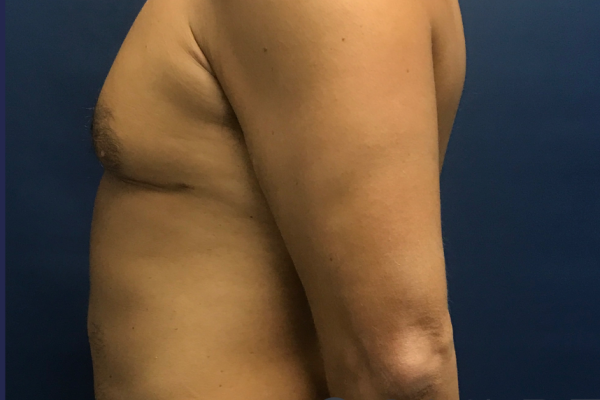 Liposuction to the Abdomen, Chest, McKinney, TX
