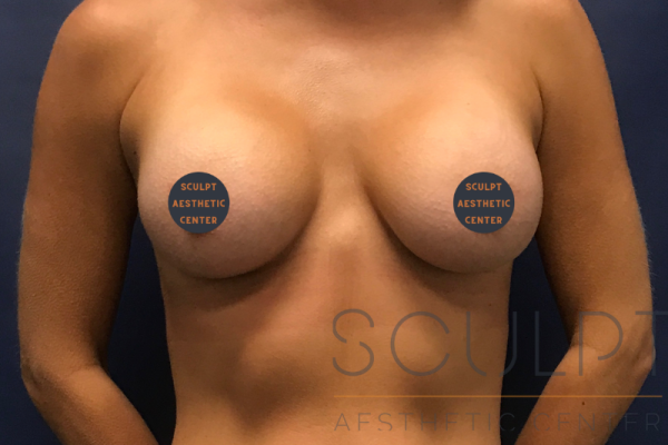 Breast Augmentation, Dallas, TX