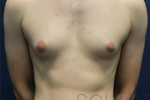 Gynecomastia Excision with Chest SCULPTing, Dallas, TX